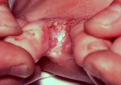 Candida albicans between the toes